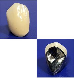 プラスチック前装冠（保険適用）