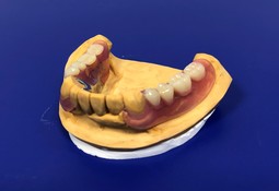 ノンクラスプ金属床義歯